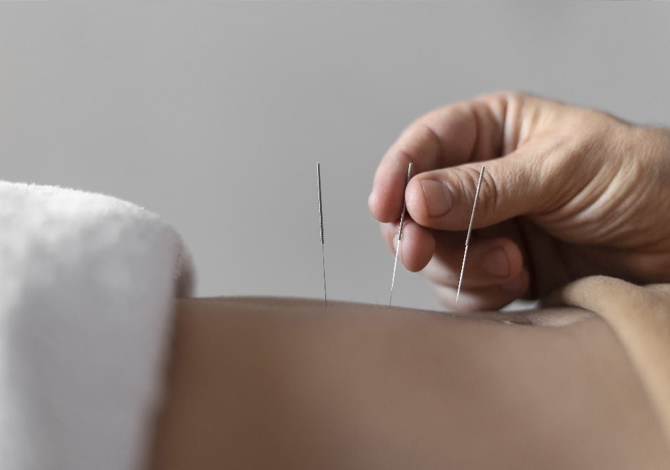 acupuntura en miraflores lima
